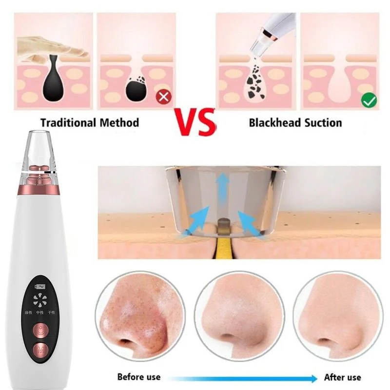 Pure Skin Rechargeable Blackhead Remover Machine - Image 4